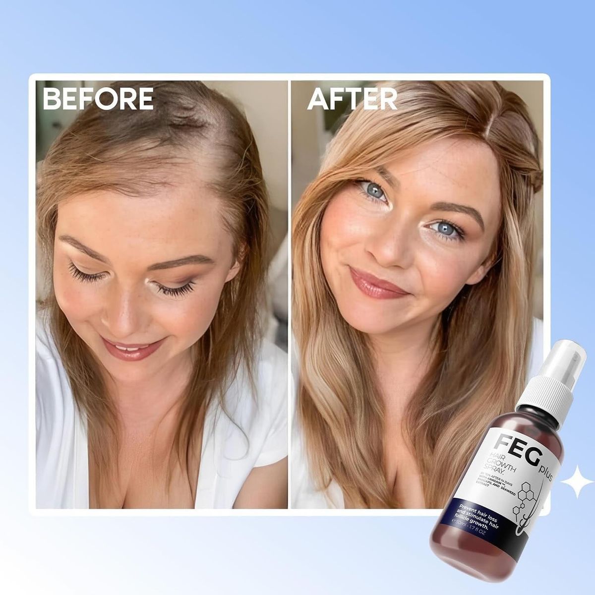 FEG Hair Growth Spray (Pack of 2) with Derma Roller for Men & Women | Hair Regrowth Solution | Free UAE Delivery